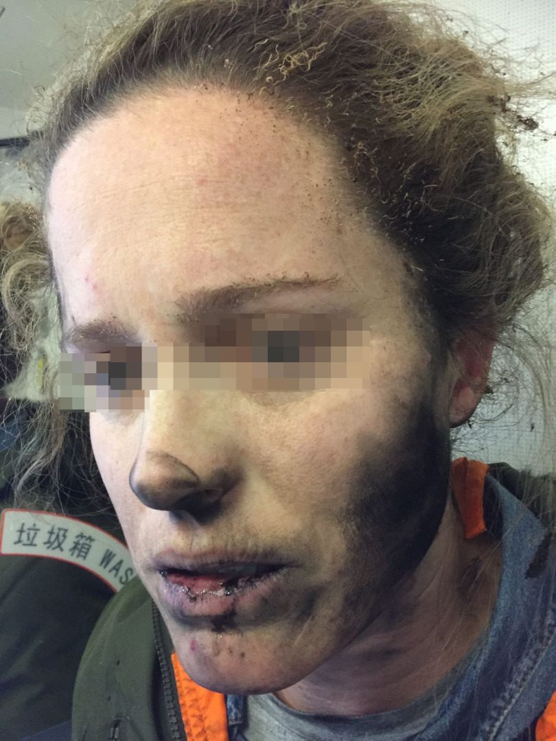 إحتراق مسافرة في طائرة جوية بسبب إنفجار السماعات الخاصة بها